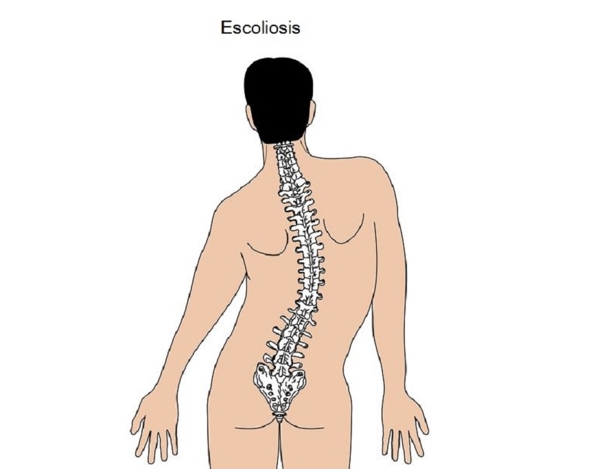 Escoliosis o desviación lateral de columna - Qué es, causas, tipos 